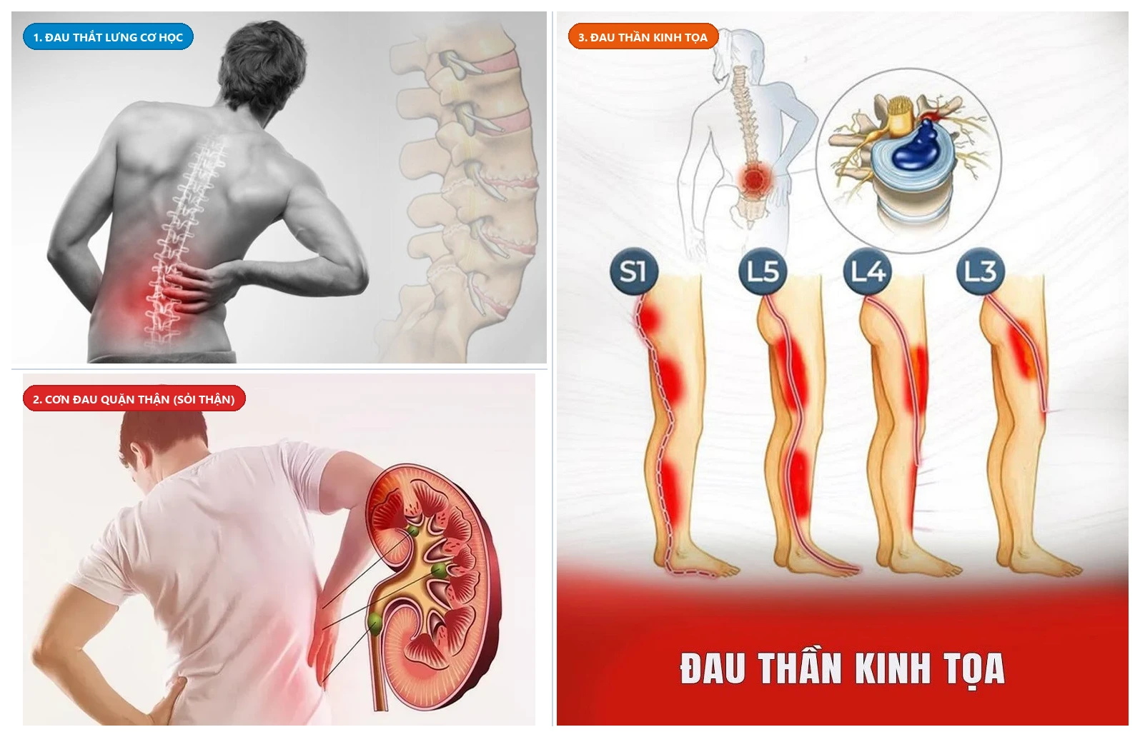 Hình ảnh đối chứng lâm sàng phân biệt Đau thắt lưng cơ học thoái hóa cột sống vs Cơn đau quặn thận do sỏi vs Đau thần kinh tọa