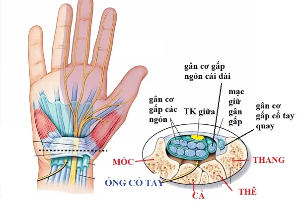 Sơ đồ giải phẫu Hội chứng ống cổ tay và dây thần kinh giữa bị chèn ép